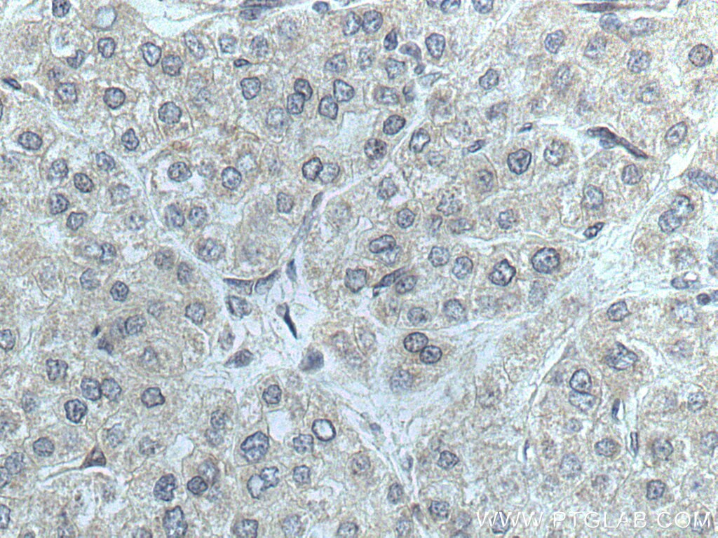 Immunohistochemistry (IHC) staining of human liver cancer tissue using NFAM1 Polyclonal antibody (14310-1-AP)