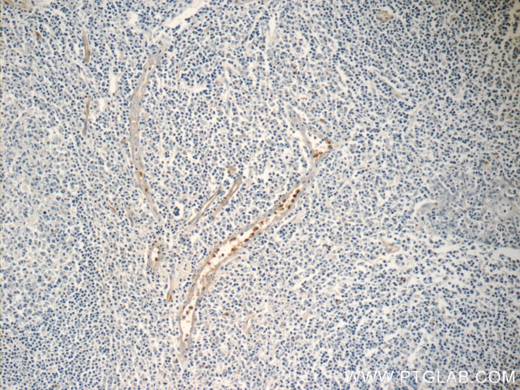 Immunohistochemistry (IHC) staining of human tonsillitis tissue using NFAM1 Polyclonal antibody (14310-1-AP)