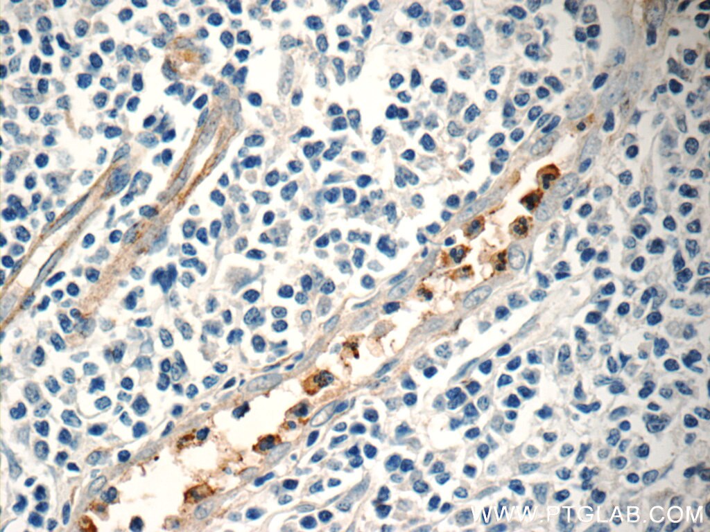 Immunohistochemistry (IHC) staining of human tonsillitis tissue using NFAM1 Polyclonal antibody (14310-1-AP)