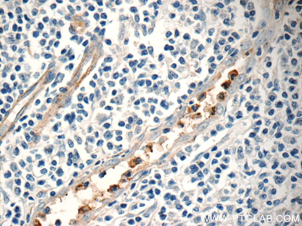 IHC staining of human tonsillitis using 14310-1-AP