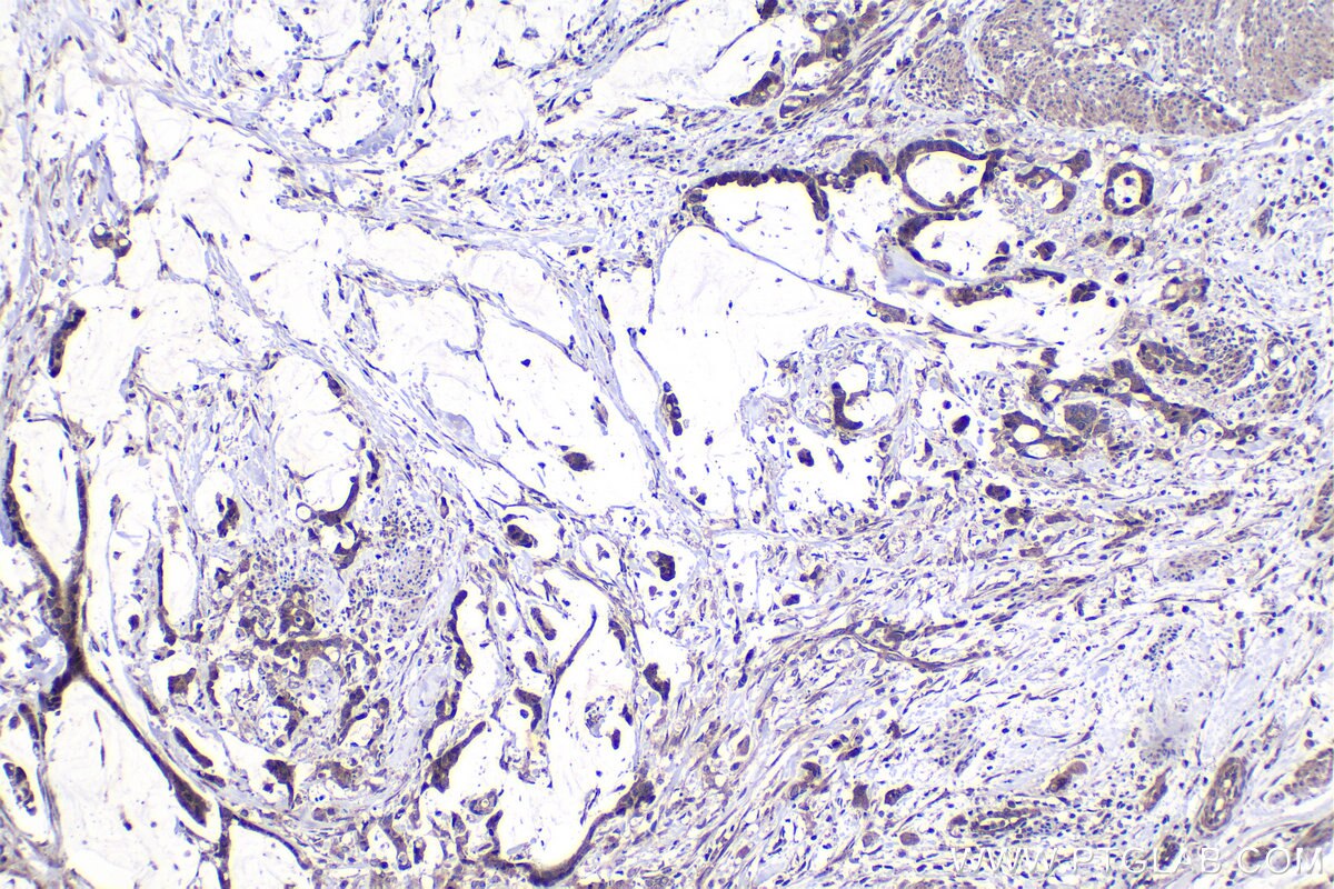 Immunohistochemistry (IHC) staining of human urothelial carcinoma tissue using NFAT5 Polyclonal antibody (21713-1-AP)