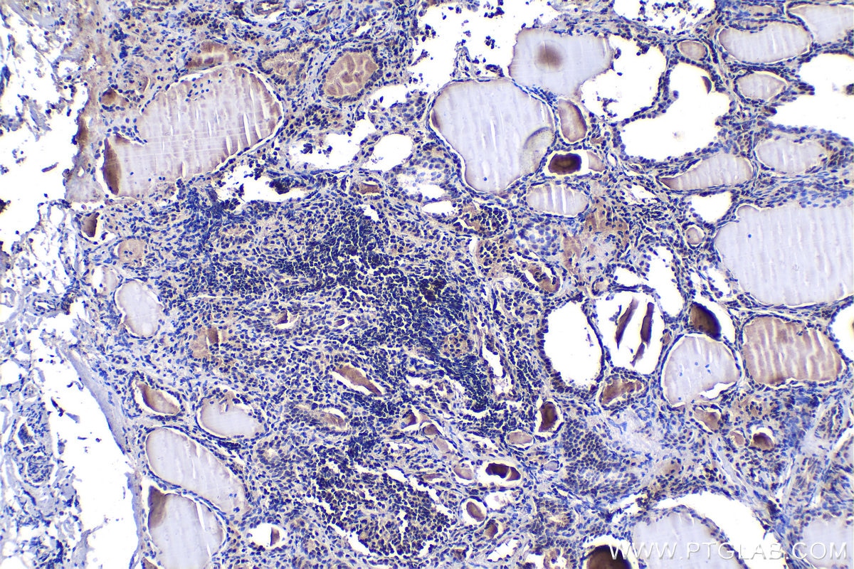 Immunohistochemistry (IHC) staining of human thyroid cancer tissue using NFAT5 Polyclonal antibody (21713-1-AP)