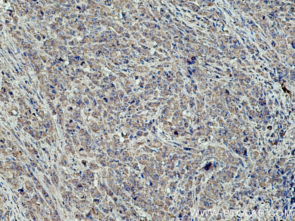IHC staining of human lymphoma using 66963-1-Ig