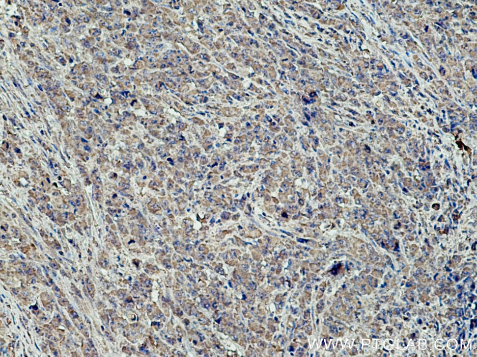 Immunohistochemistry (IHC) staining of human lymphoma tissue using NFATC1 Monoclonal antibody (66963-1-Ig)