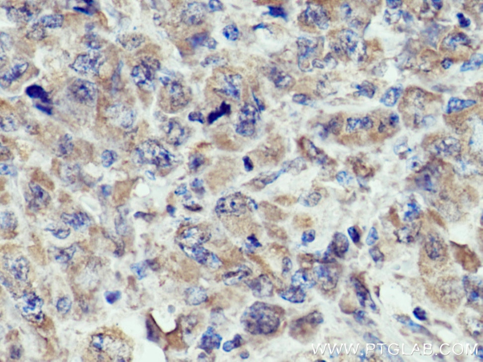 Immunohistochemistry (IHC) staining of human lymphoma tissue using NFATC1 Monoclonal antibody (66963-1-Ig)