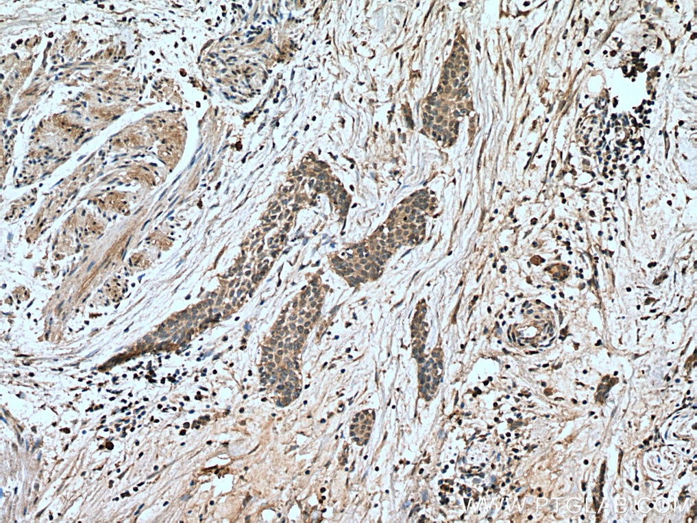 Immunohistochemistry (IHC) staining of human urothelial carcinoma tissue using NFATC1 Monoclonal antibody (66963-1-Ig)