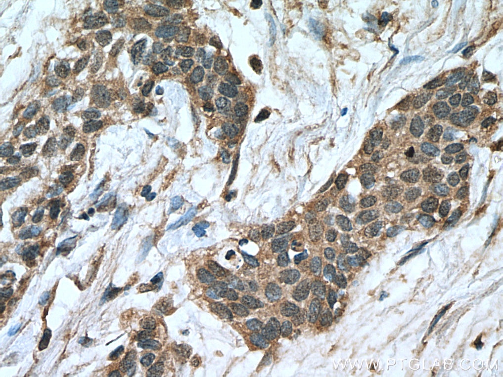 Immunohistochemistry (IHC) staining of human urothelial carcinoma tissue using NFATC1 Monoclonal antibody (66963-1-Ig)