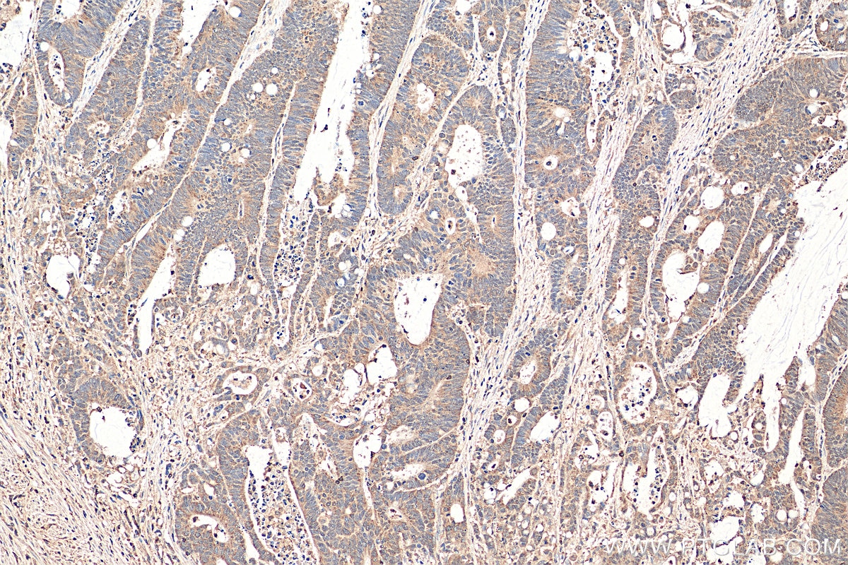 IHC staining of human colon cancer using 22023-1-AP