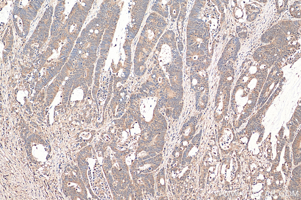 Immunohistochemistry (IHC) staining of human colon cancer tissue using NFATC2 Polyclonal antibody (22023-1-AP)