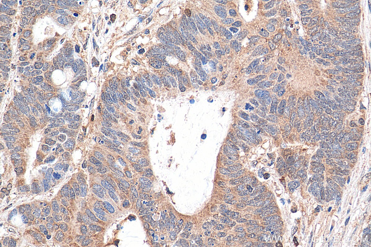 Immunohistochemistry (IHC) staining of human colon cancer tissue using NFATC2 Polyclonal antibody (22023-1-AP)
