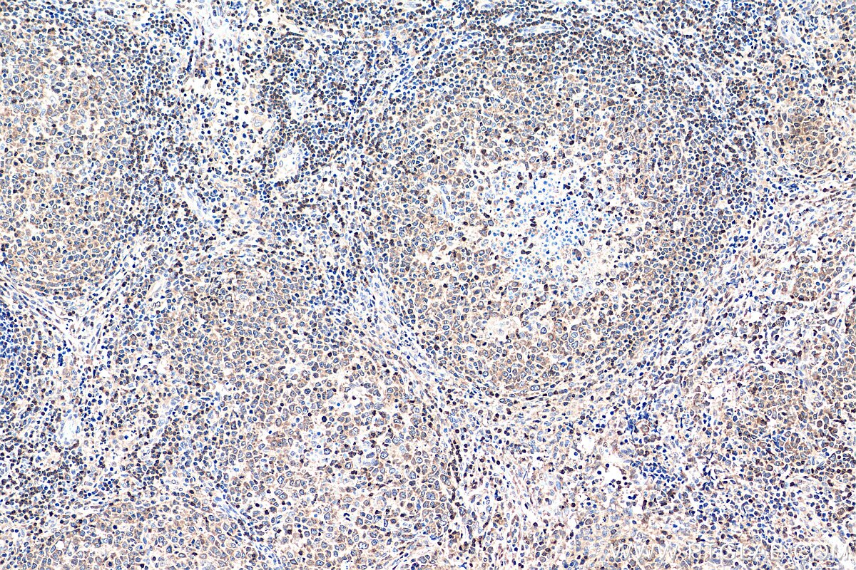 Immunohistochemistry (IHC) staining of human lymphoma tissue using NFATC2 Polyclonal antibody (22023-1-AP)