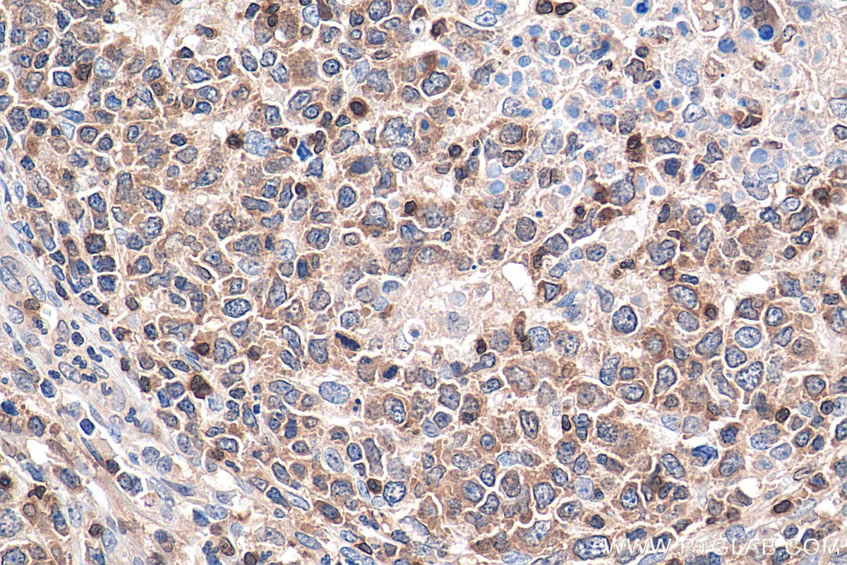 Immunohistochemistry (IHC) staining of human lymphoma tissue using NFATC2 Polyclonal antibody (22023-1-AP)