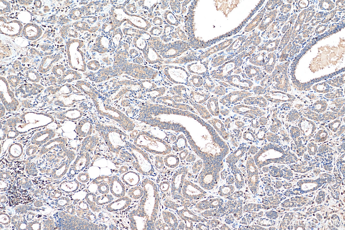 IHC staining of human breast cancer using 22023-1-AP