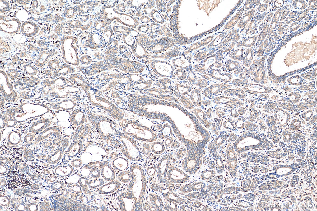 Immunohistochemistry (IHC) staining of human breast cancer tissue using NFATC2 Polyclonal antibody (22023-1-AP)