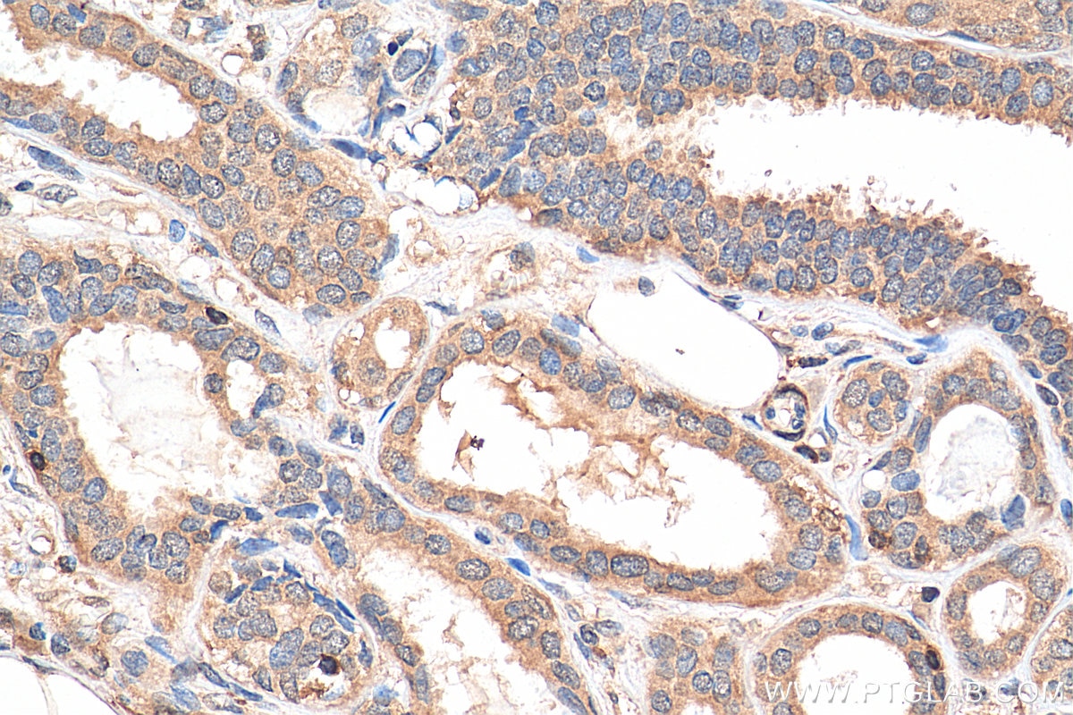 Immunohistochemistry (IHC) staining of human breast cancer tissue using NFATC2 Polyclonal antibody (22023-1-AP)