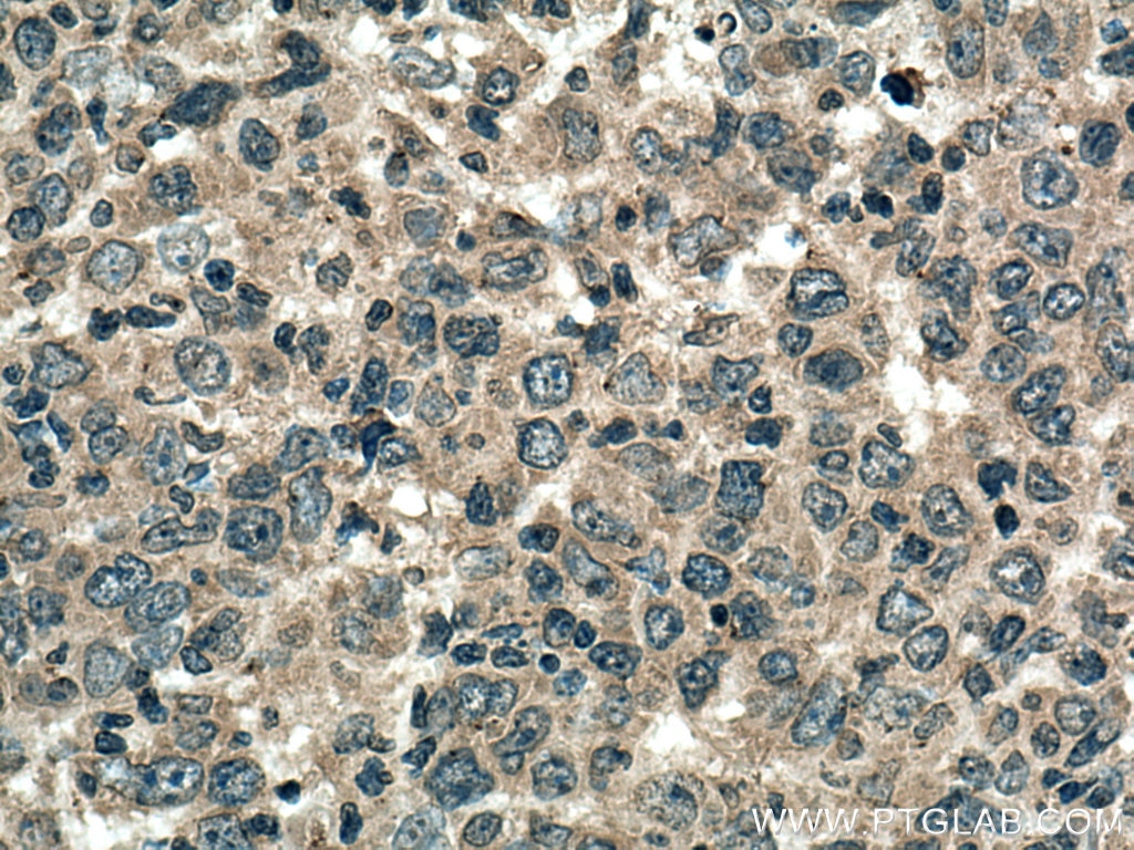Immunohistochemistry (IHC) staining of human lymphoma tissue using NFATC2 Monoclonal antibody (66917-1-Ig)