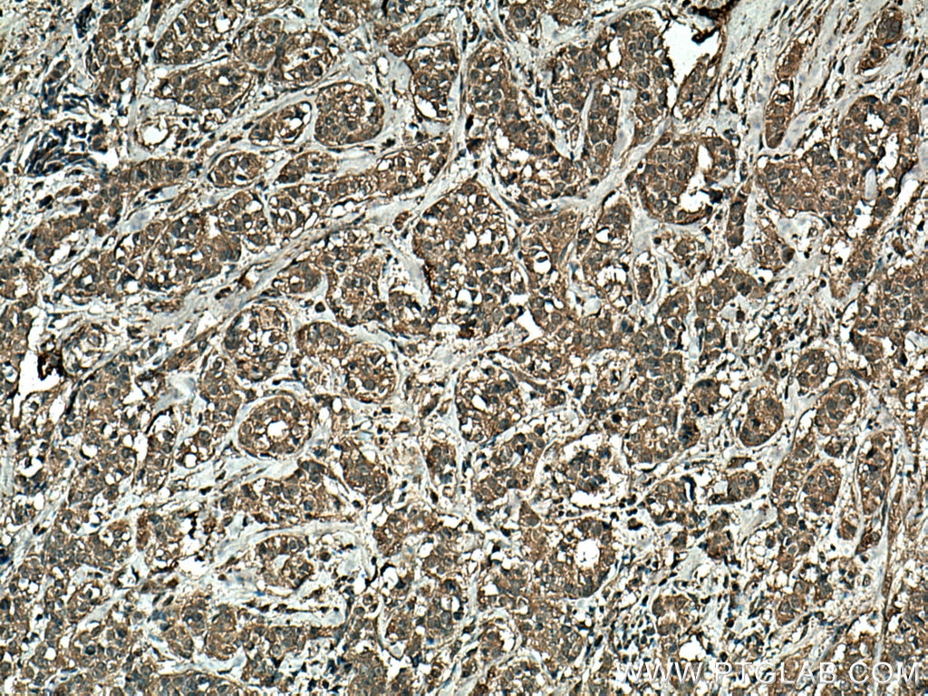 Immunohistochemistry (IHC) staining of human breast cancer tissue using NFATC2 Monoclonal antibody (66917-1-Ig)