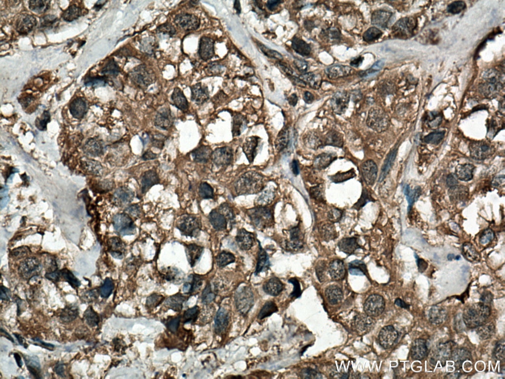 Immunohistochemistry (IHC) staining of human breast cancer tissue using NFATC2 Monoclonal antibody (66917-1-Ig)