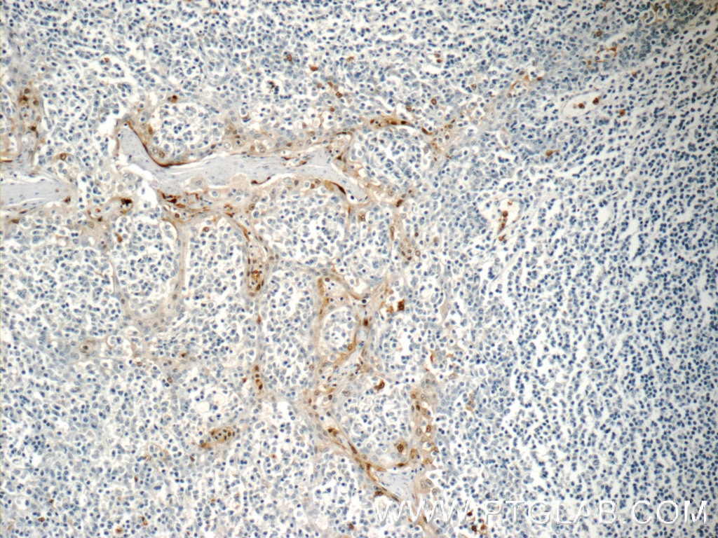 Immunohistochemistry (IHC) staining of human tonsillitis tissue using NFATC2IP Polyclonal antibody (11667-1-AP)
