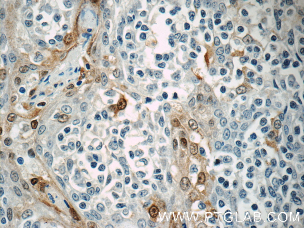 Immunohistochemistry (IHC) staining of human tonsillitis tissue using NFATC2IP Polyclonal antibody (11667-1-AP)