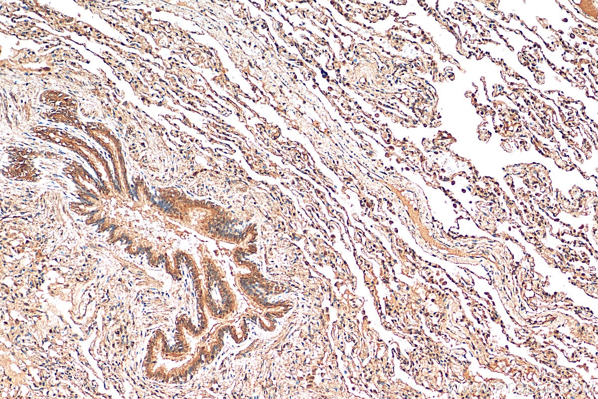 Immunohistochemistry (IHC) staining of human lung cancer tissue using NFATC4 Polyclonal antibody (26311-1-AP)