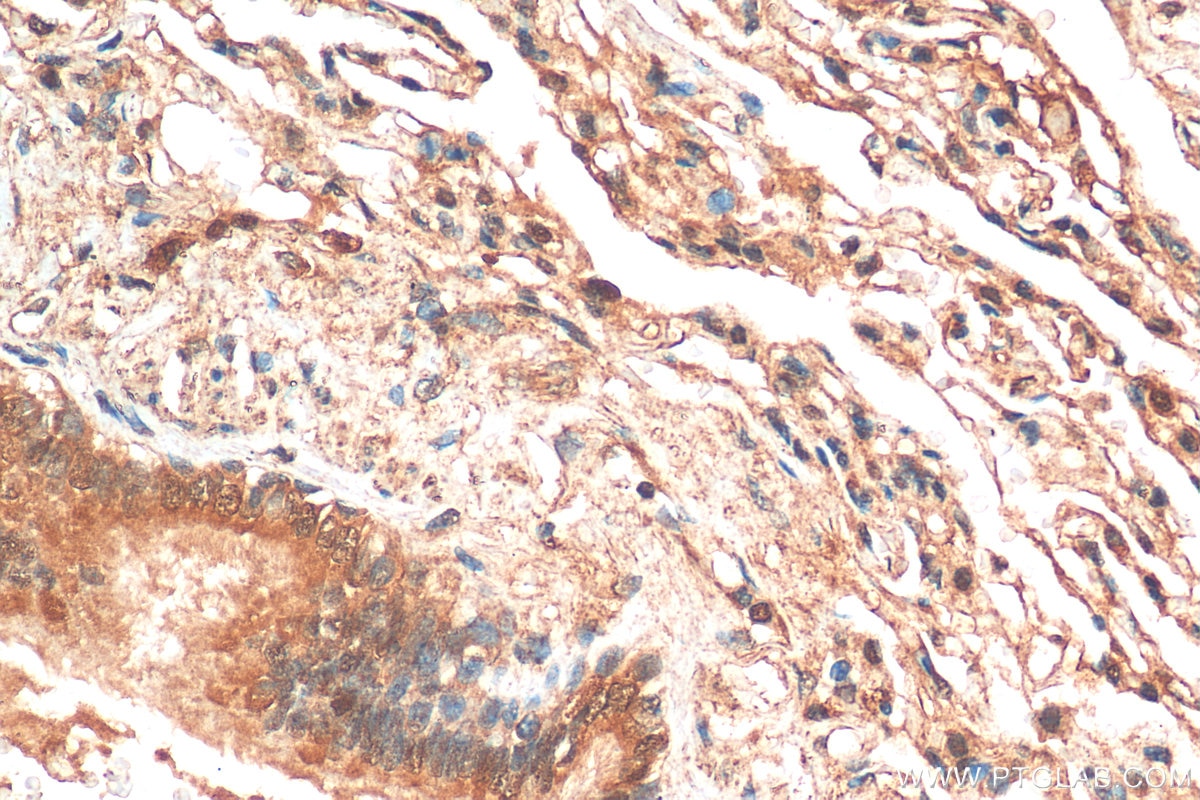 Immunohistochemistry (IHC) staining of human lung cancer tissue using NFATC4 Polyclonal antibody (26311-1-AP)