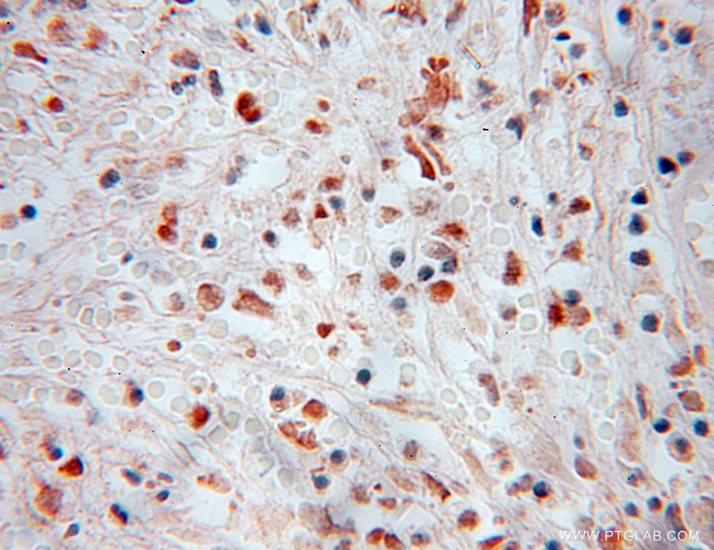 Immunohistochemistry (IHC) staining of human colon cancer tissue using NFE2 Polyclonal antibody (11089-1-AP)