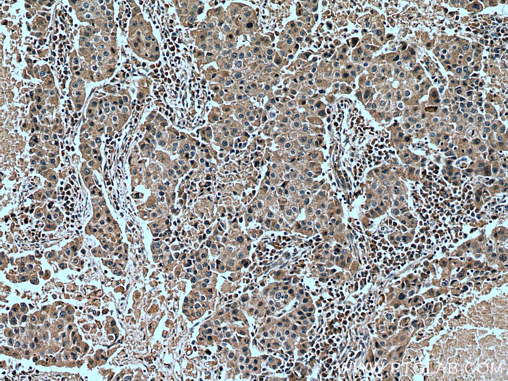 Immunohistochemistry (IHC) staining of human breast cancer tissue using NFE2L1 Polyclonal antibody (12936-1-AP)