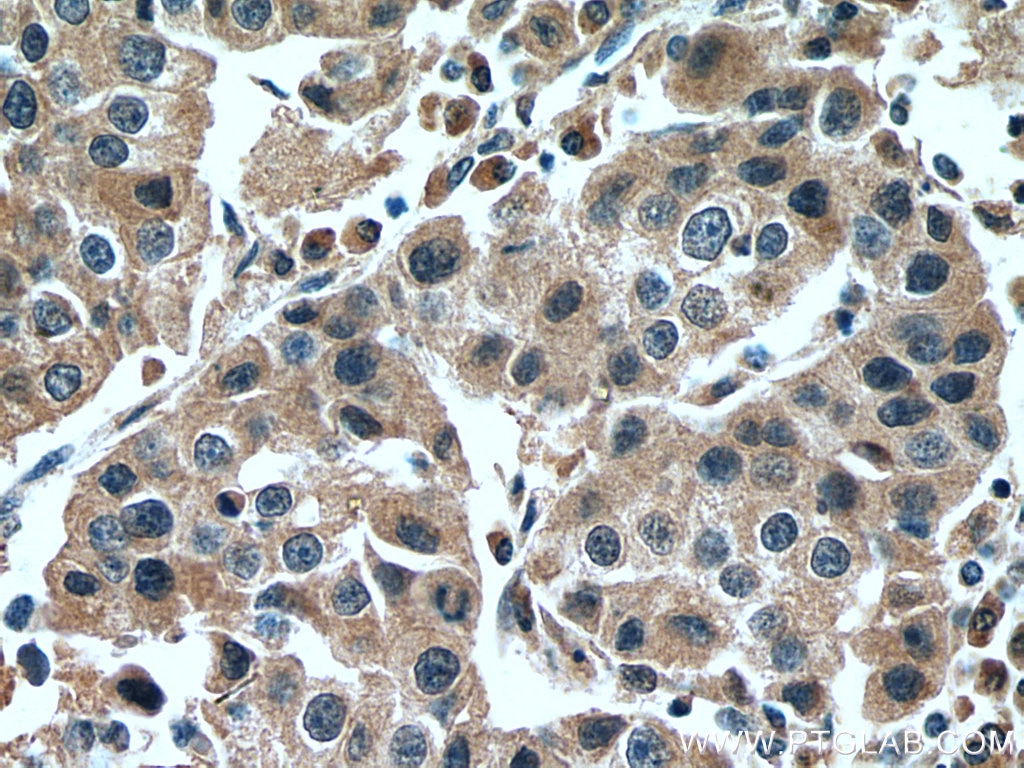 Immunohistochemistry (IHC) staining of human breast cancer tissue using NFE2L1 Polyclonal antibody (12936-1-AP)