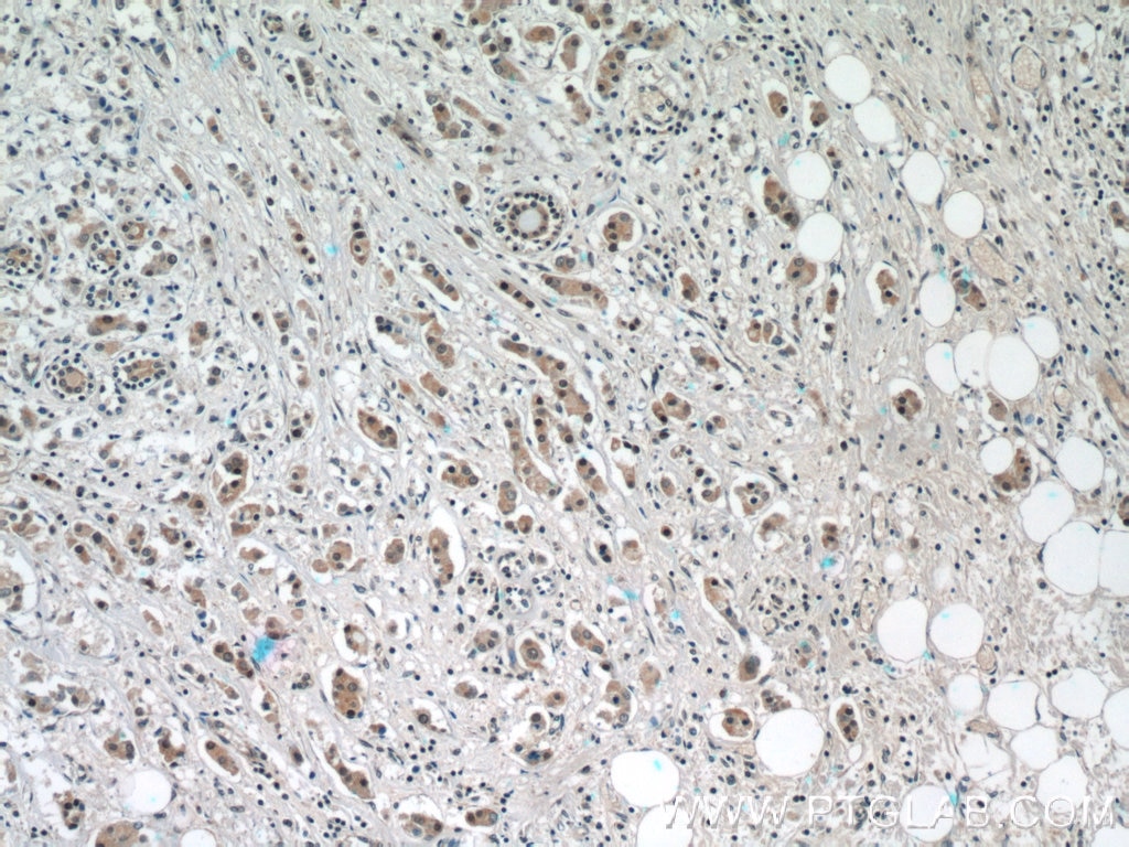 Immunohistochemistry (IHC) staining of human breast cancer tissue using NRF2, NFE2L2 Polyclonal antibody (16396-1-AP)