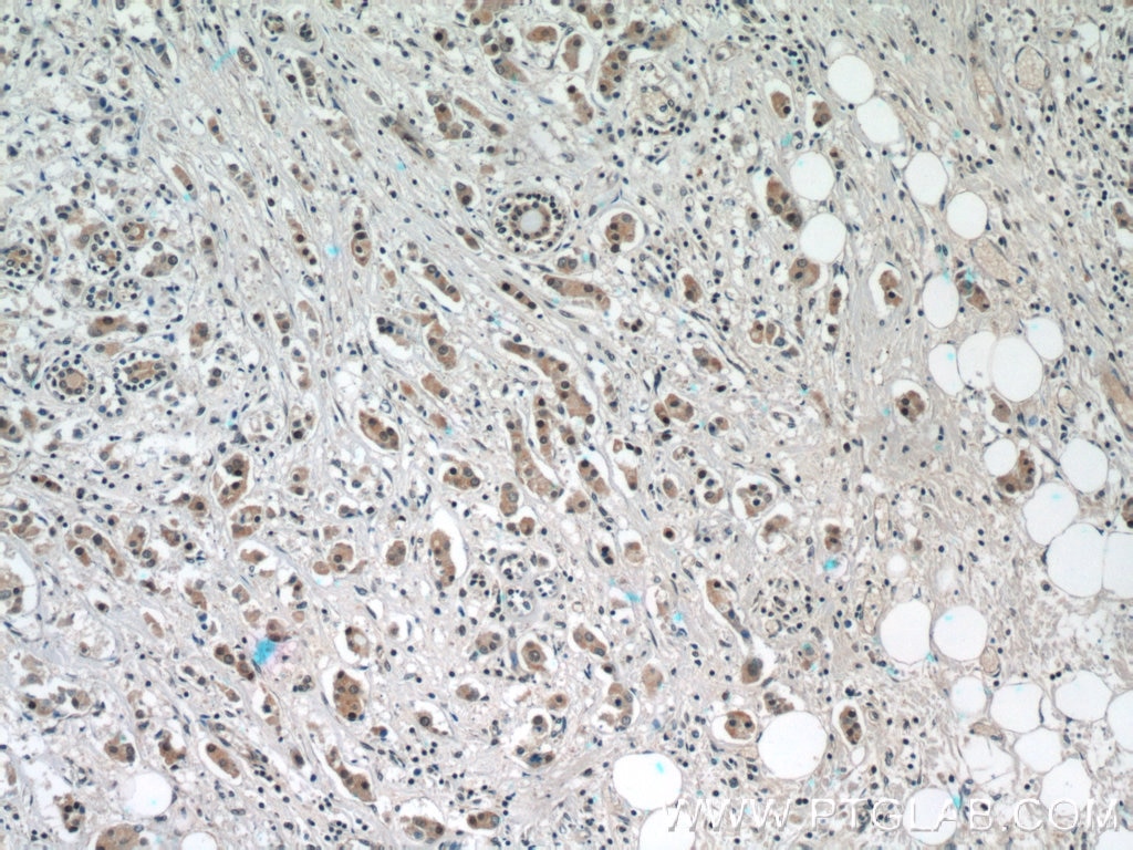 IHC staining of human breast cancer using 16396-1-AP