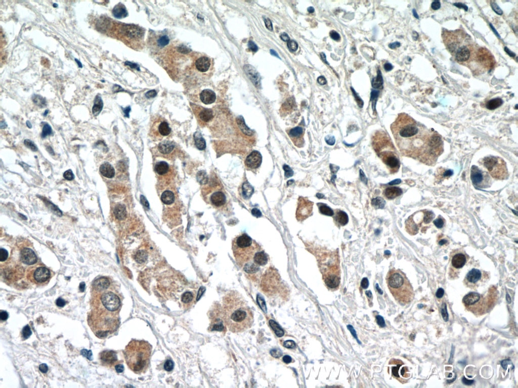 Immunohistochemistry (IHC) staining of human breast cancer tissue using NRF2, NFE2L2 Polyclonal antibody (16396-1-AP)