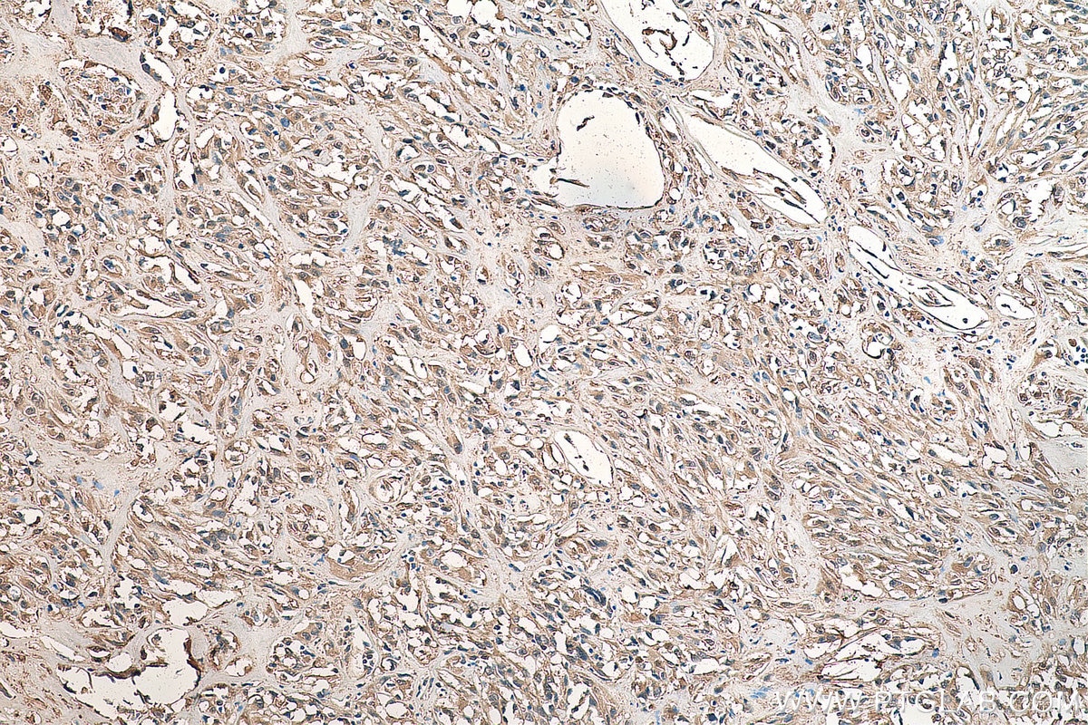 Immunohistochemistry (IHC) staining of human renal cell carcinoma tissue using NRF2, NFE2L2 Polyclonal antibody (16396-1-AP)