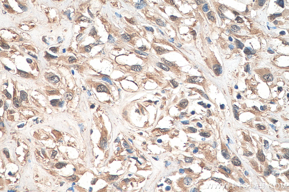 Immunohistochemistry (IHC) staining of human renal cell carcinoma tissue using NRF2, NFE2L2 Polyclonal antibody (16396-1-AP)
