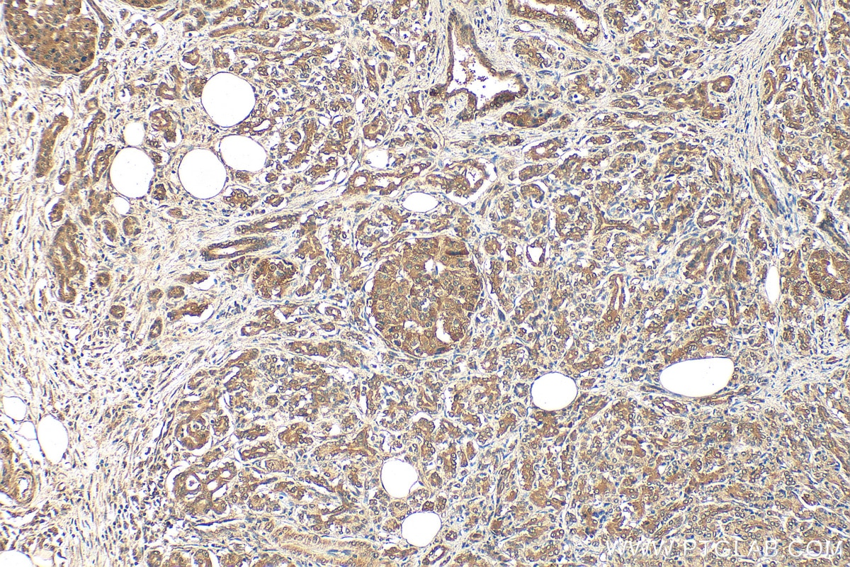 Immunohistochemistry (IHC) staining of human pancreas cancer tissue using NRF2, NFE2L2 Polyclonal antibody (16396-1-AP)