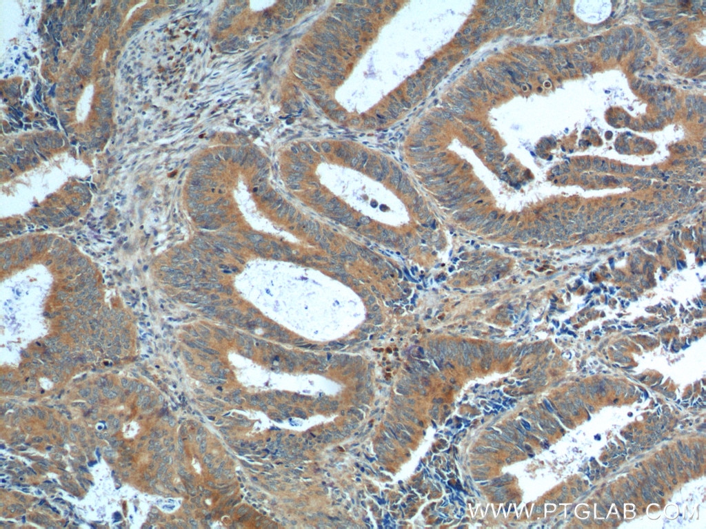 Immunohistochemistry (IHC) staining of human colon cancer tissue using NRF2, NFE2L2 Polyclonal antibody (16396-1-AP)