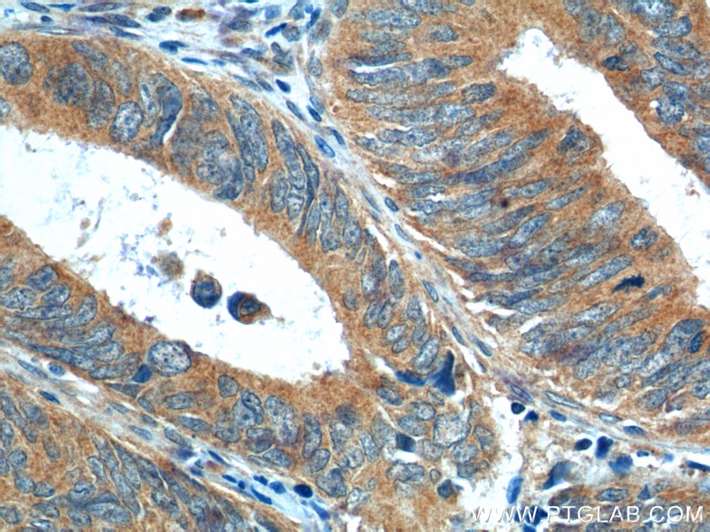 Immunohistochemistry (IHC) staining of human colon cancer tissue using NRF2, NFE2L2 Polyclonal antibody (16396-1-AP)