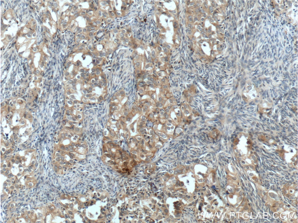 Immunohistochemistry (IHC) staining of human ovary tumor tissue using NRF2, NFE2L2 Polyclonal antibody (16396-1-AP)
