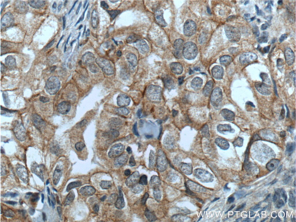 Immunohistochemistry (IHC) staining of human ovary tumor tissue using NRF2, NFE2L2 Polyclonal antibody (16396-1-AP)