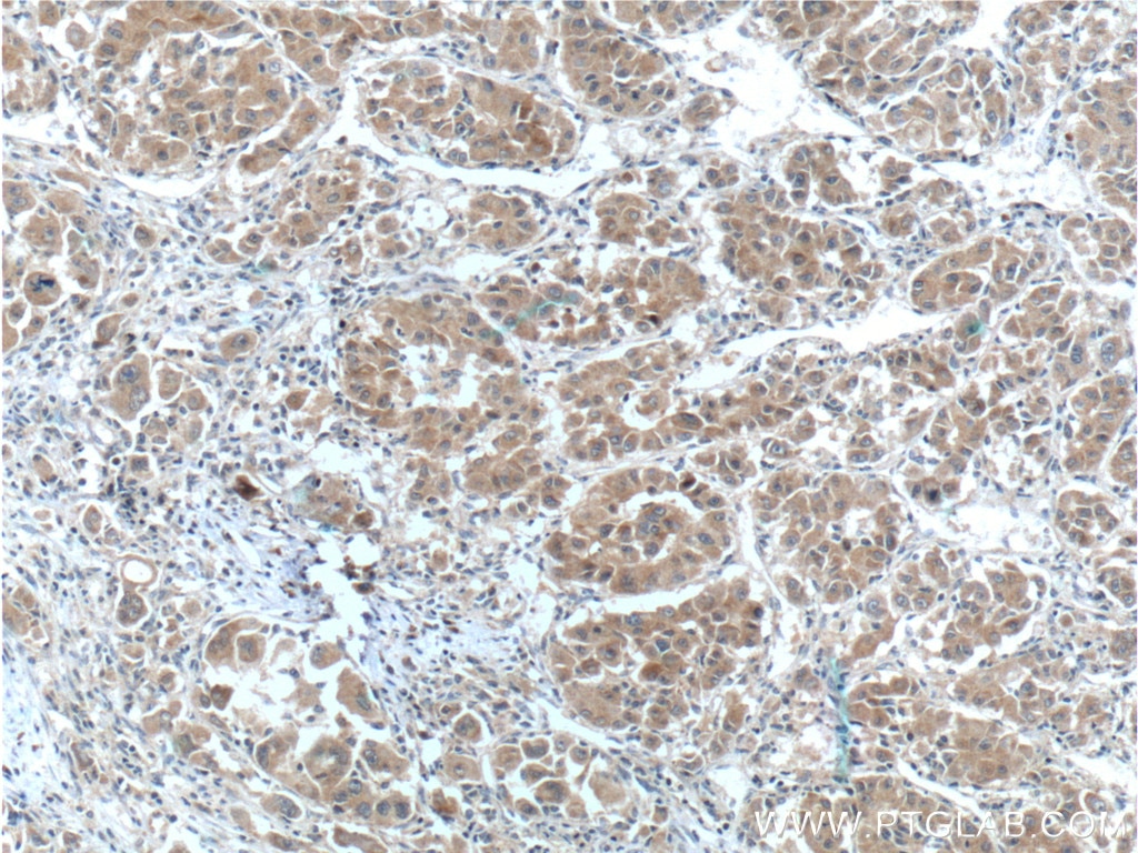 Immunohistochemistry (IHC) staining of human liver cancer tissue using NRF2, NFE2L2 Polyclonal antibody (16396-1-AP)