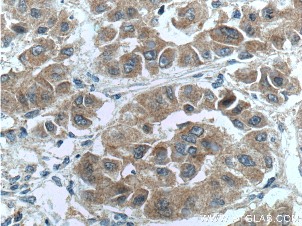 Immunohistochemistry (IHC) staining of human liver cancer tissue using NRF2, NFE2L2 Polyclonal antibody (16396-1-AP)