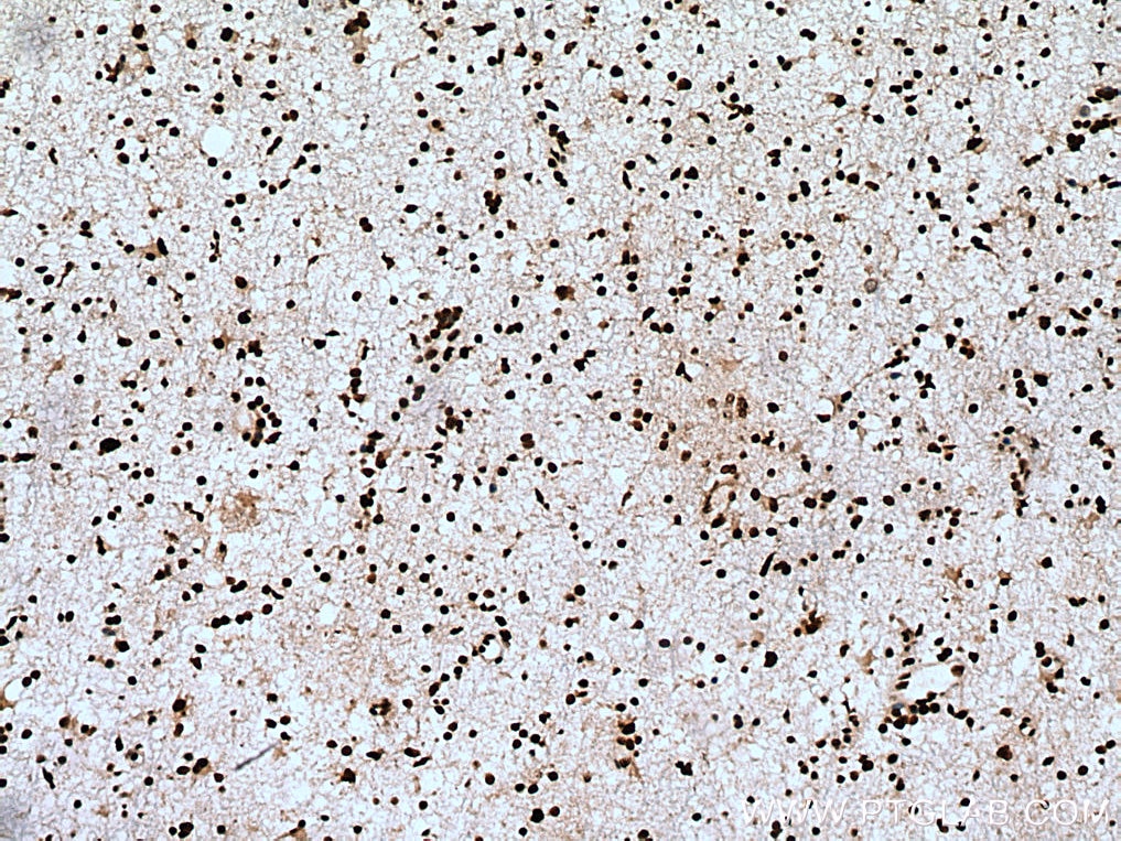 Immunohistochemistry (IHC) staining of human gliomas tissue using NFIA Polyclonal antibody (11750-1-AP)