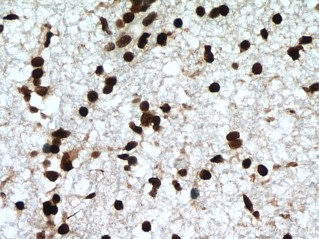 Immunohistochemistry (IHC) staining of human gliomas tissue using NFIA Polyclonal antibody (11750-1-AP)