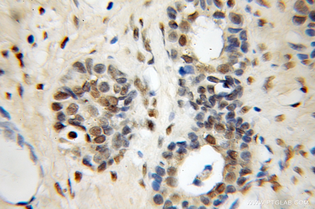 Immunohistochemistry (IHC) staining of human prostate cancer tissue using NFIA Polyclonal antibody (11750-1-AP)