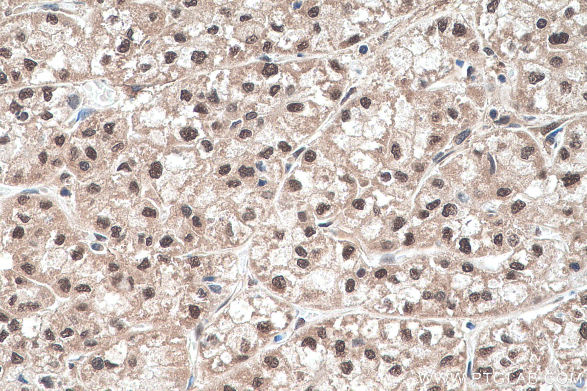 Immunohistochemistry (IHC) staining of human liver cancer tissue using NFIC Polyclonal antibody (16399-1-AP)