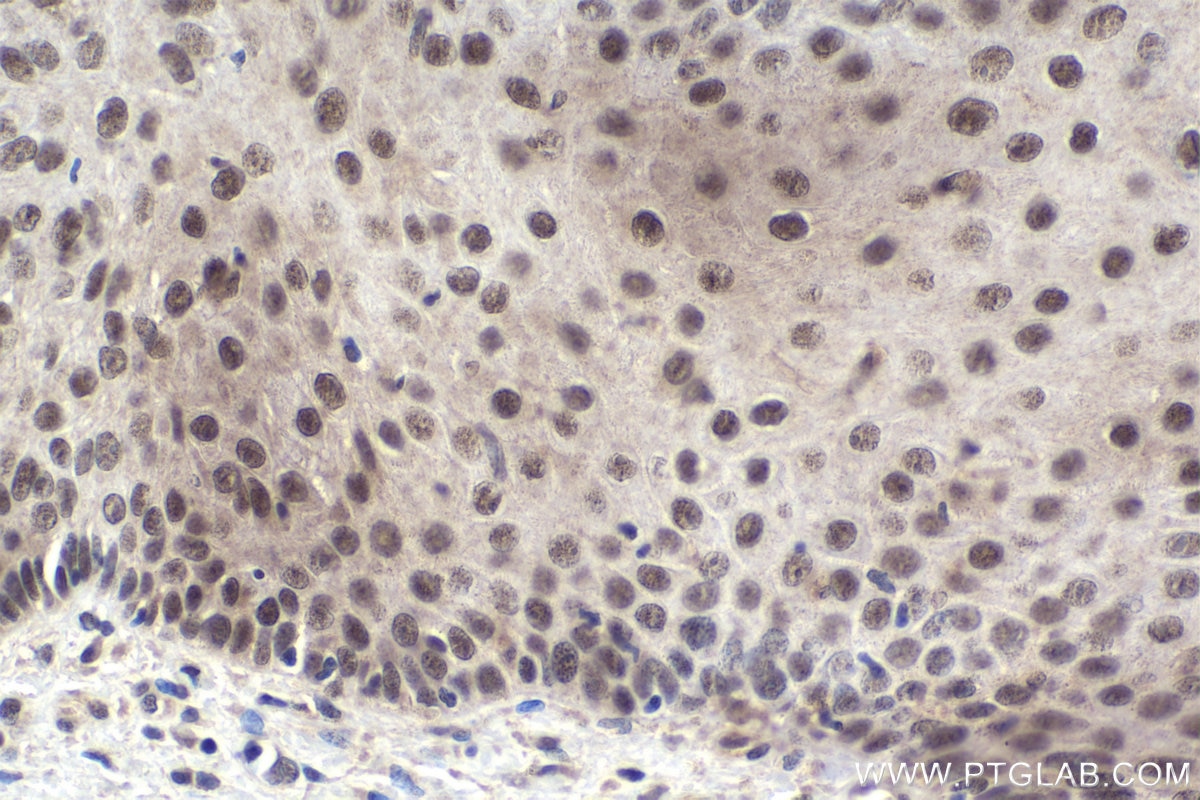Immunohistochemistry (IHC) staining of human skin cancer tissue using NFIL3 Polyclonal antibody (11773-1-AP)