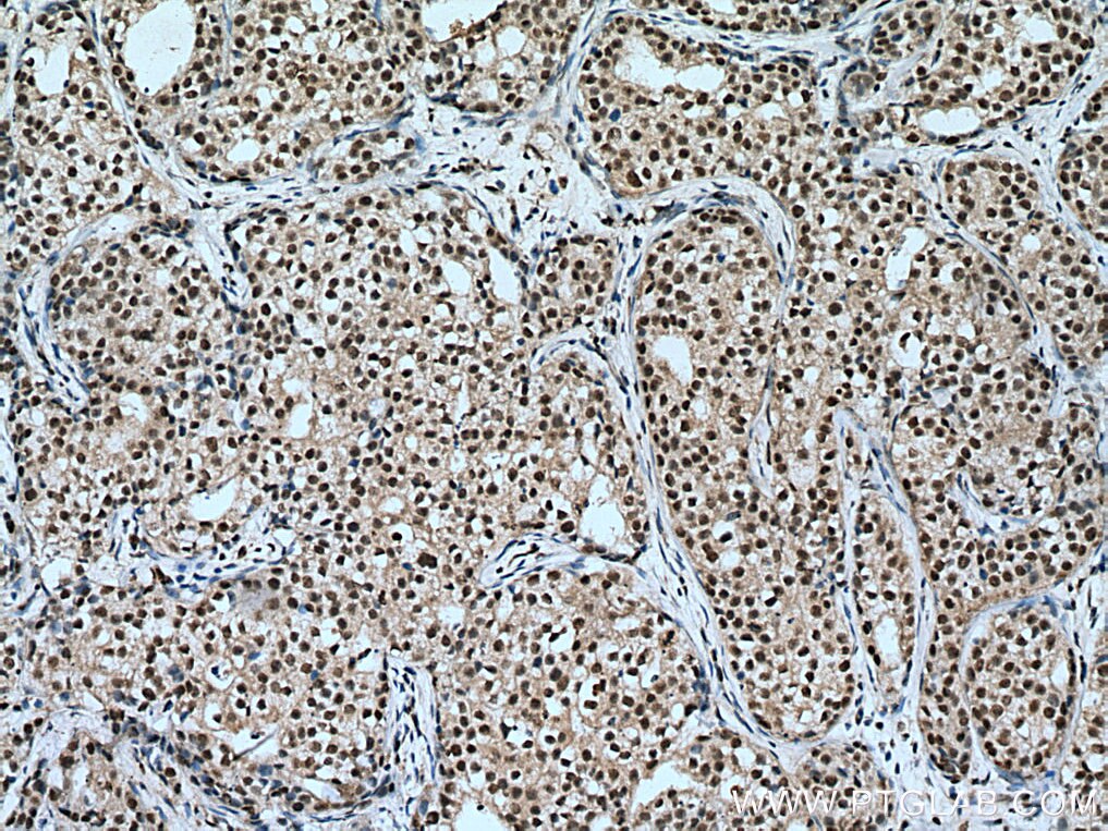 IHC staining of human breast cancer using 66992-1-Ig