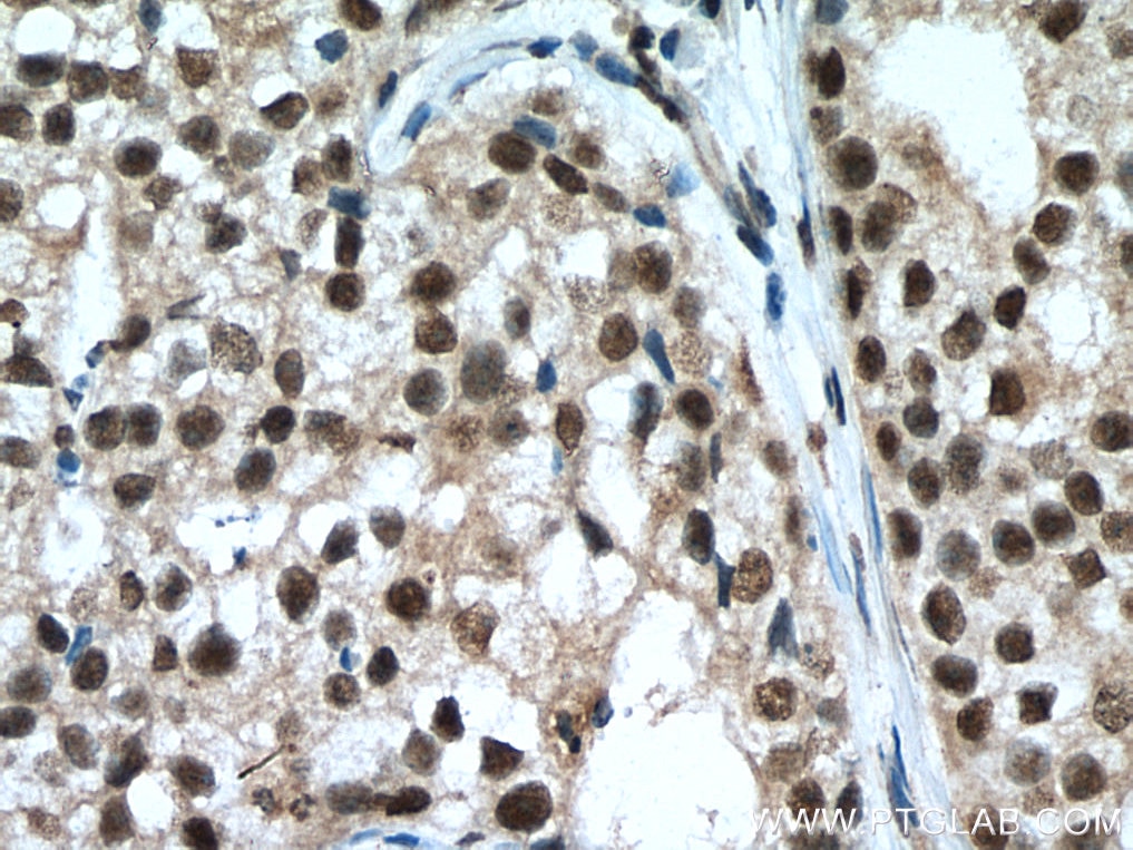 Immunohistochemistry (IHC) staining of human breast cancer tissue using NFKB1,p105,p50 Monoclonal antibody (66992-1-Ig)