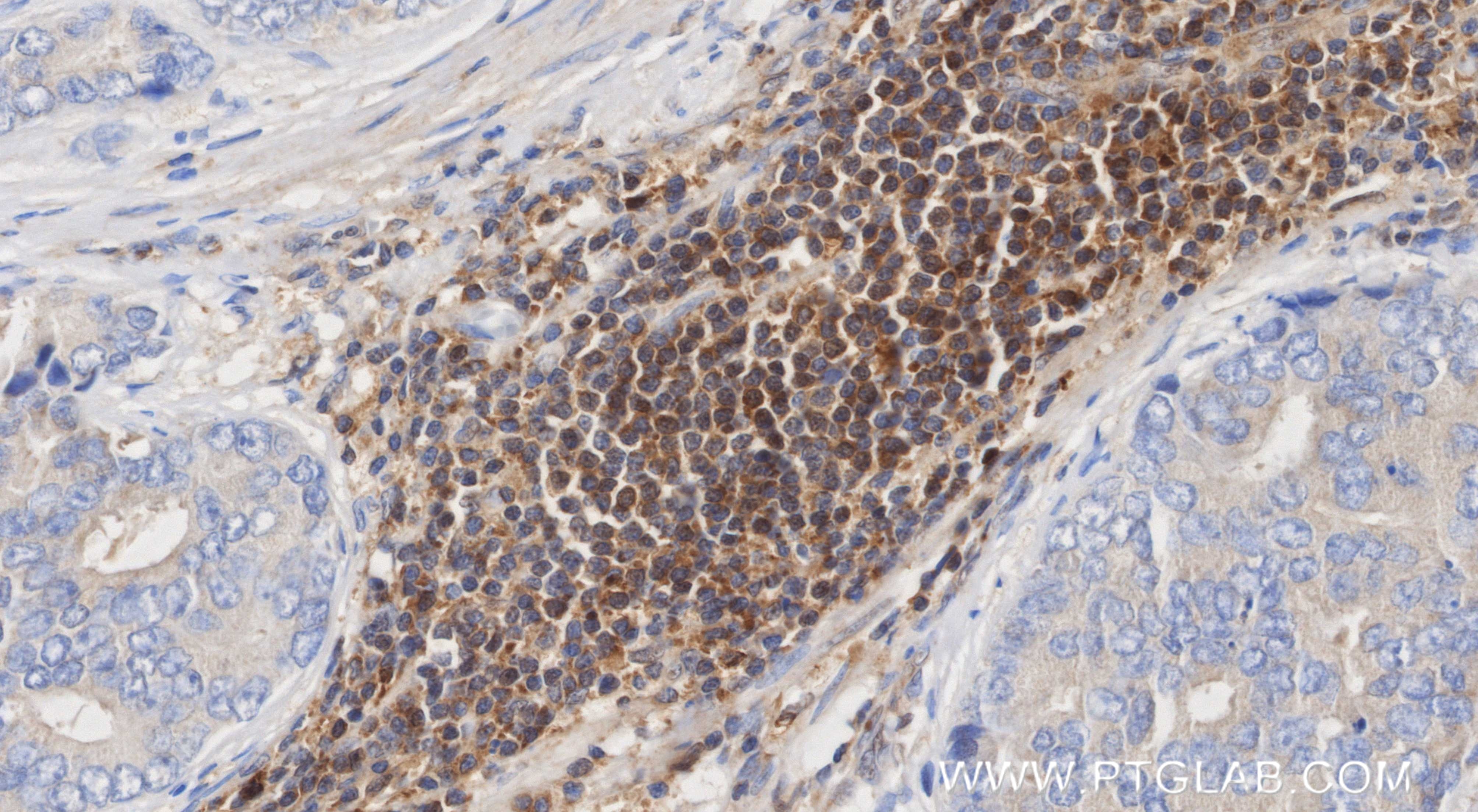 Immunohistochemistry (IHC) staining of human prostate cancer tissue using NFKB1 p105/p50-Specific Recombinant monoclonal ant (81261-2-RR)