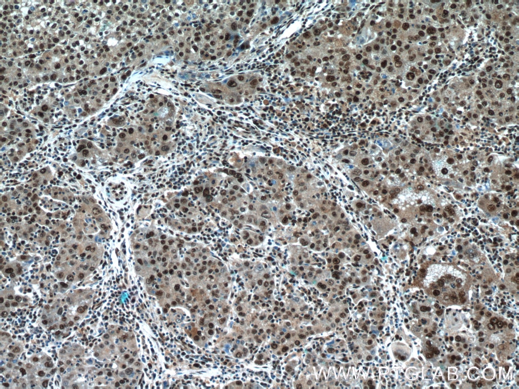 Immunohistochemistry (IHC) staining of human liver cancer tissue using NFKB2 Polyclonal antibody (10409-2-AP)